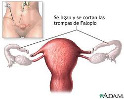 Mujer: Tumores de ovario se forman en las trompas de Falopio