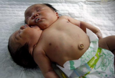 En China Nació Bebe con Dos Cabezas