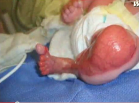 Insólito bebe nace sin piel